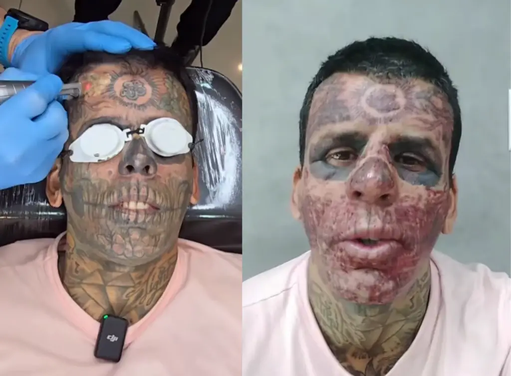 Homem tatuado de caveira se converte e tenta remoção a laser